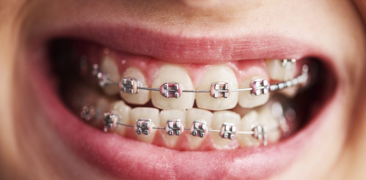 Comprendre le remboursement de l’orthodontie en France