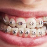 Comprendre le remboursement de l’orthodontie en France