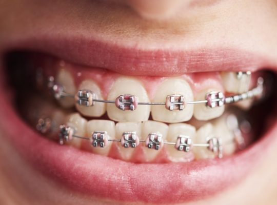 Comprendre le remboursement de l’orthodontie en France